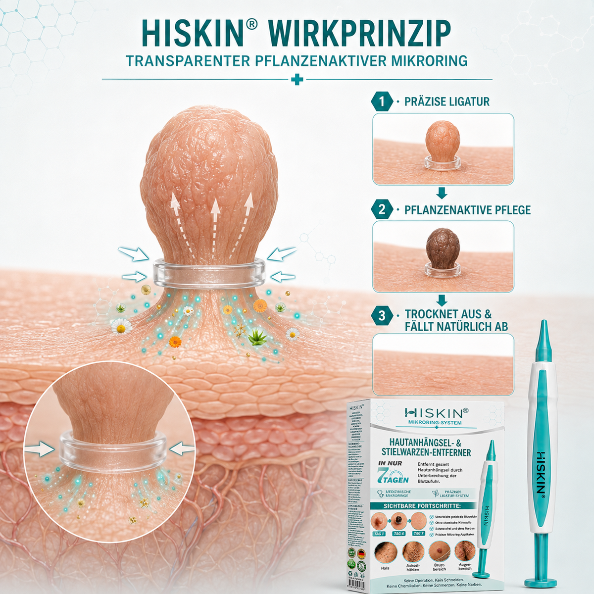 HISKIN® Hautanhängsel- & Stielwarzen-Entferner mit pflanzlicher Pflegeformel – Präzises Mikroring-System für zu Hause