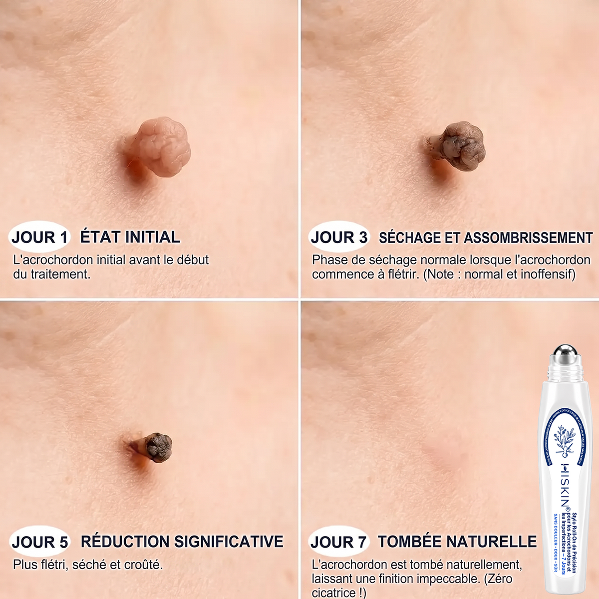 𝐇𝐈𝐒𝐊𝐈𝐍®👩‍⚕️ 𝐄𝐟𝐟𝐚𝐜𝐞𝐮𝐫 𝐝𝐞 𝐒𝐤𝐢𝐧 𝐓𝐚𝐠𝐬 𝐞𝐭 𝐝’𝐈𝐦𝐩𝐞𝐫𝐟𝐞𝐜𝐭𝐢𝐨𝐧𝐬 𝐞𝐧 𝟕 𝐉𝐨𝐮𝐫𝐬 — 𝐒𝐭𝐲𝐥𝐨 𝐑𝐨𝐥𝐥-𝐎𝐧 𝐀𝐯𝐚𝐧𝐜é, 𝐒𝐚𝐧𝐬 𝐃𝐨𝐮𝐥𝐞𝐮𝐫 𝐞𝐭 𝐒𝐚𝐧𝐬 𝐂𝐢𝐜𝐚𝐭𝐫𝐢𝐜𝐞
